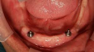 overdenture2