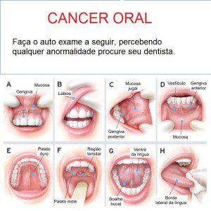 canceroralautoexame