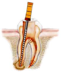 Endodontia em Santo André e Grande ABC Paulista