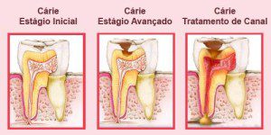 estagios da cárie